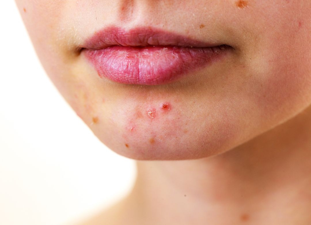 Nguyên nhân gây mụn quanh miệng và tầm quan trọng của liệu trình trị mụn ở spa