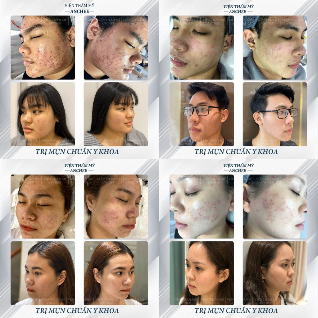 Quy trình nặn mụn ẩn dưới da chuyên sâu tại spa nặn mụn