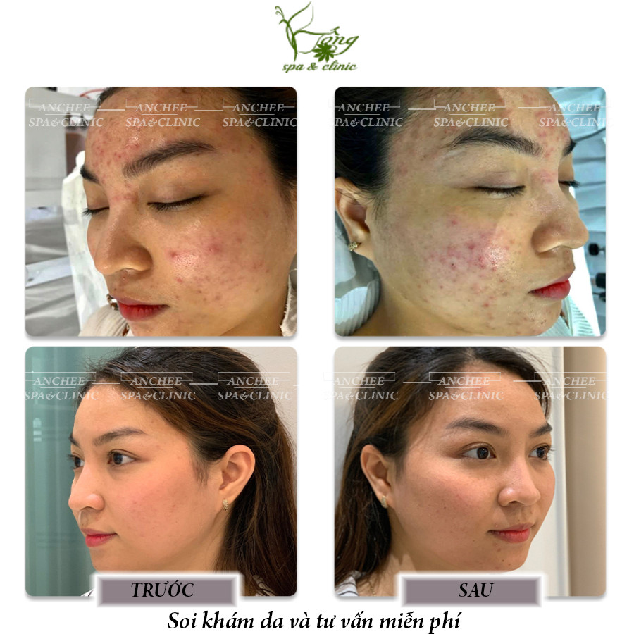 Quy trình phi kim trị mụn và sẹo rỗ tại spa nặn mụn uy tín