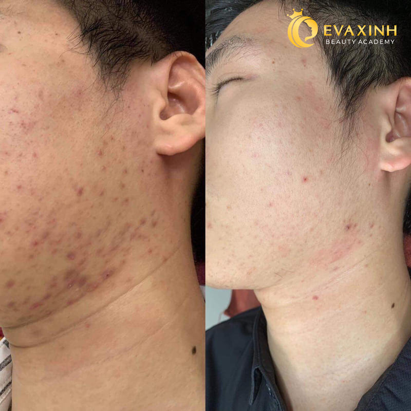 Sát khuẩn đều đặn vùng da vừa nặn mụn ở spa giúp vết thương nhanh lành và giảm nguy cơ sẹo