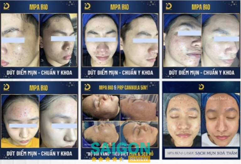 Spa Dr Choice Clinic lăn kim trị mụn, thâm, sẹo TPHCM
