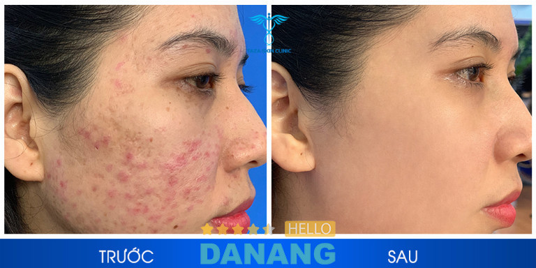 Taza Skin Clinic Đà Nẵng với công nghệ trị mụn Acnes Peel tiên tiến giúp loại bỏ mụn hiệu quả