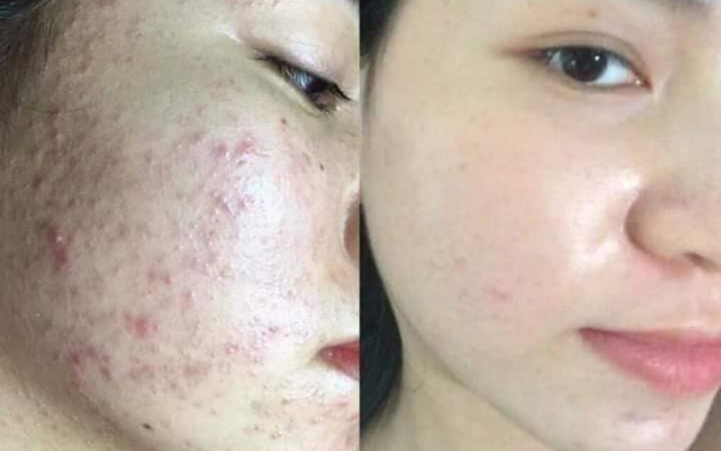 Thoa dưỡng chất chuyên biệt cho làn da sau chăm sóc tại spa