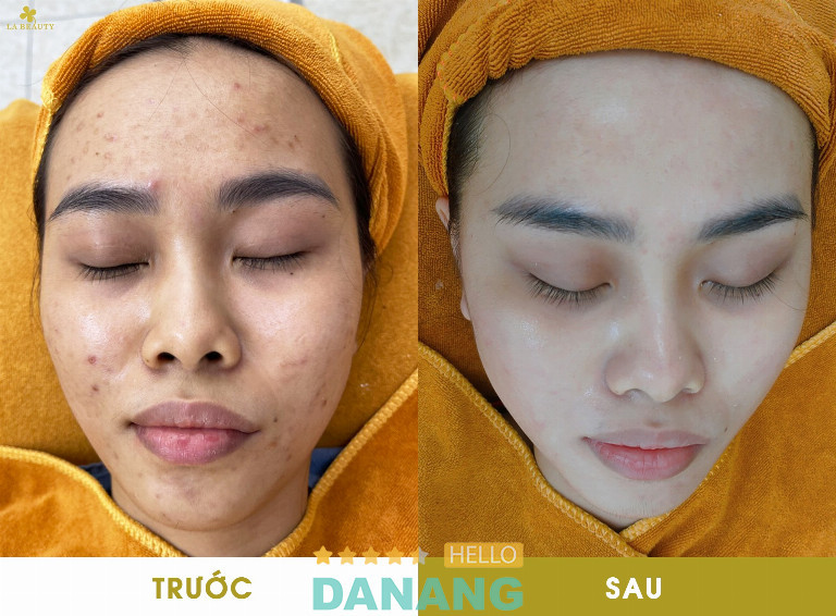 Tình trạng mụn được cải thiện rõ rệt sau khi thực hiện liệu trình tại La Beauty Đà Nẵng, mang lại làn da mịn màng