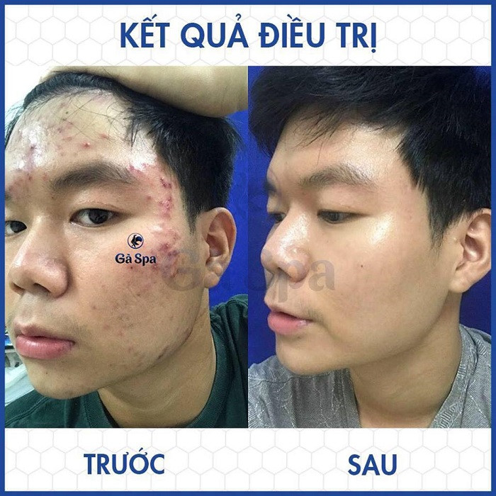 Trước và sau điều trị mụn tại Clair Center – Hành trình lấy lại làn da mịn màng