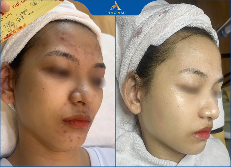 Trước và sau điều trị mụn thâm cho khách hàng tại Clair Center Hà Nội