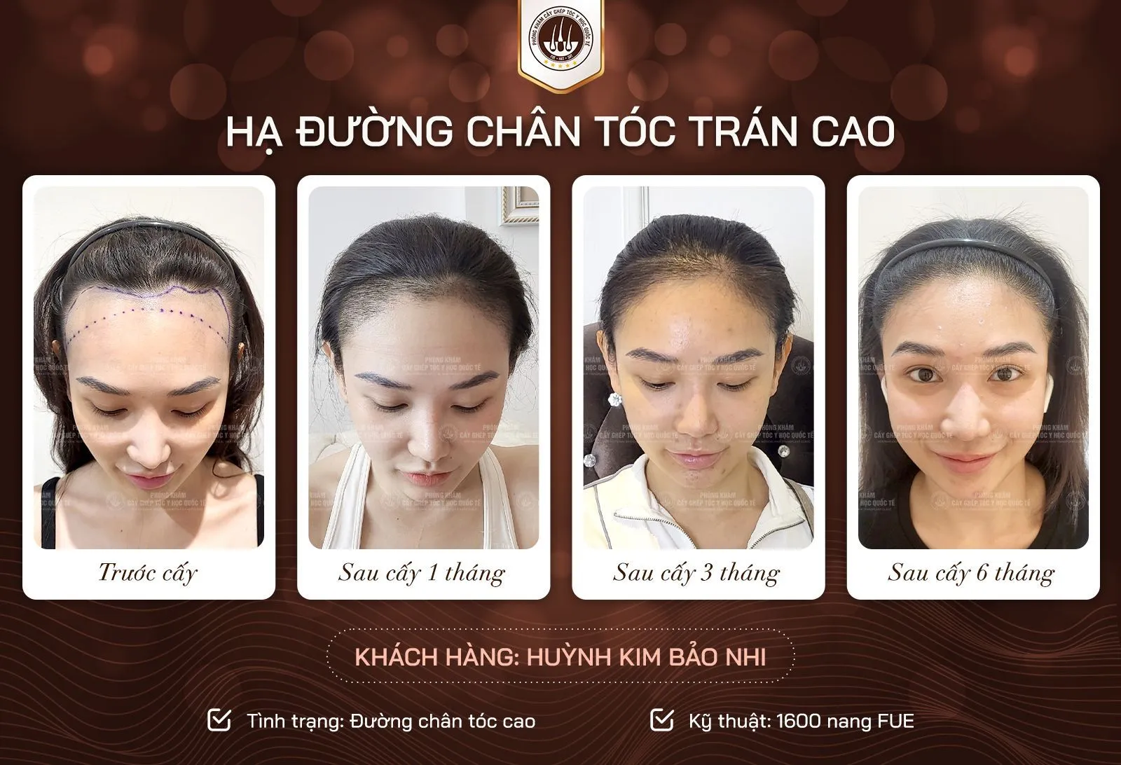 Bác sĩ y khoa đang tư vấn cho bệnh nhân về việc cấy tóc