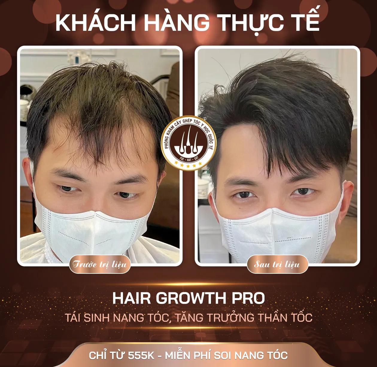 Cấy tóc tự thân là giải pháp triệt để, vĩnh viễn thay thế các cách cắt tóc cho người hói tạm thời