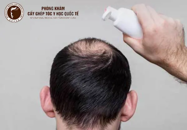 Tóc thưa ở xoáy và cách nhận biết