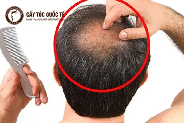 Nguyên nhân rụng tóc và cách khắc phục xoáy tóc