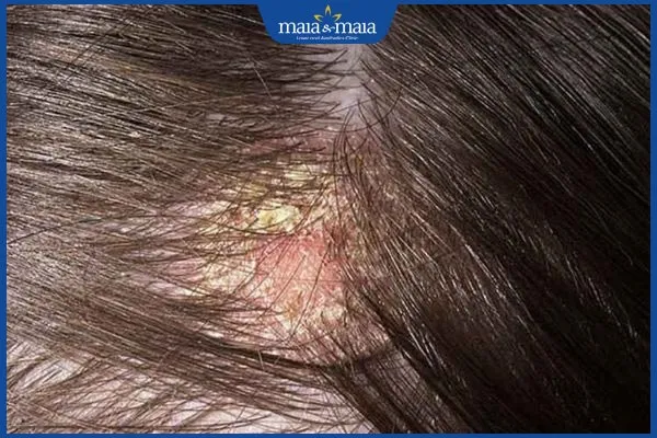 Hình ảnh da đầu bị nấm