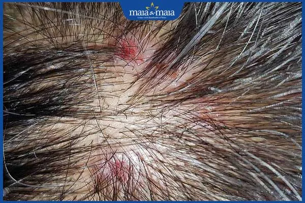 Hình ảnh mô tả bệnh viêm nang tóc, một biến chứng khi thực hiện cách nhổ tóc sâu không đúng