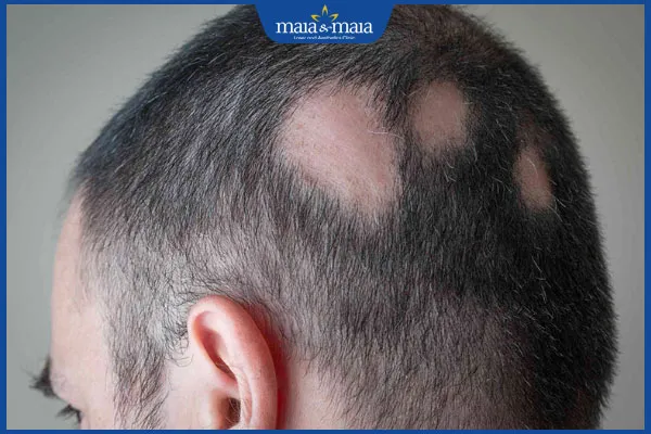 Biểu hiện rụng tóc bệnh lý, số lượng tóc rụng vượt quá mức bình thường