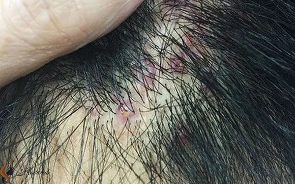 Các biểu hiện của viêm chân tóc ở da đầu với các mụn mủ nhỏ