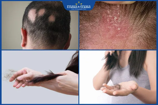 Các loại rụng tóc và nguyên nhân khác nhau cần được chẩn đoán chính xác