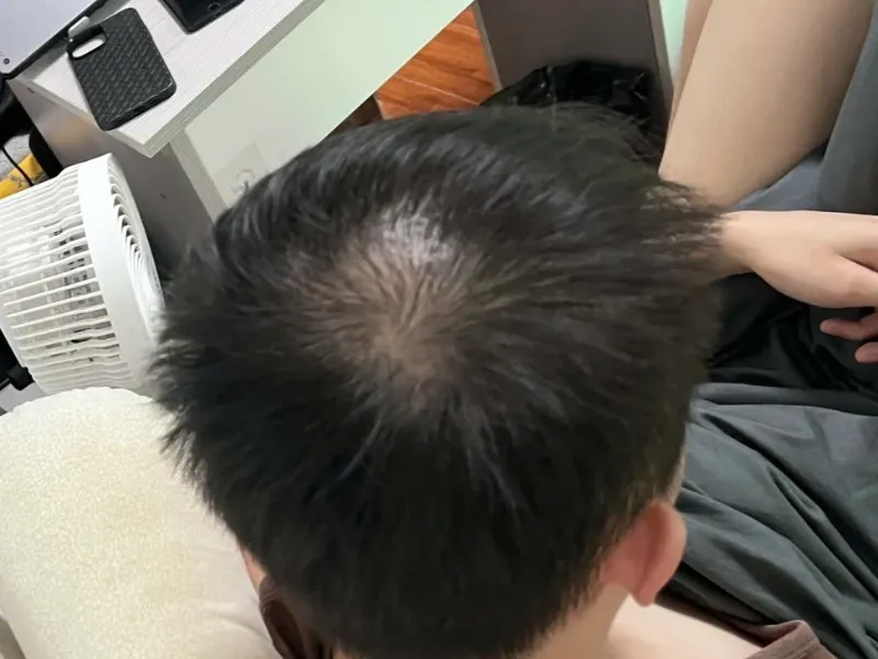 Người đàn ông đang nhìn vào gương và tự kiểm tra tình trạng rụng tóc ở vùng thái dương