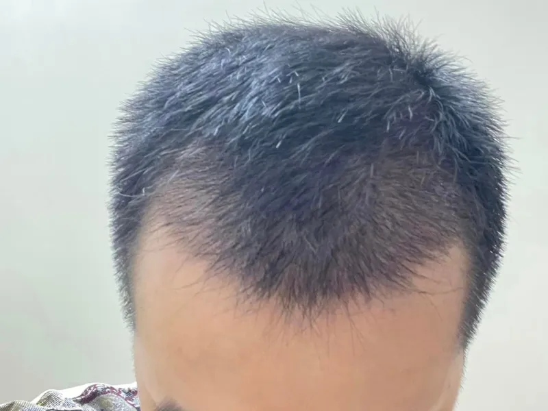 Bác sĩ tư vấn, trao đổi chuyên sâu với khách hàng về liệu trình điều trị rụng tóc và cấy tóc