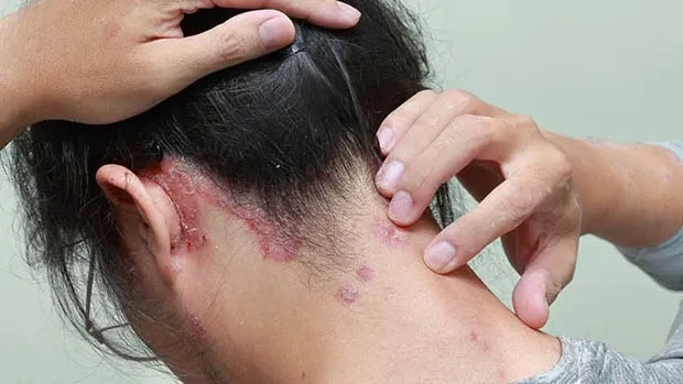 Không nên tạo kiểu tóc quá chặt ở người bệnh vảy nến da đầu