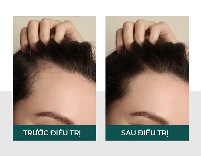 Khách hàng cải thiện tình trạng tóc thưa mỏng sau khi trải nghiệm liệu trình chuyên sâu Derma Hair Loss.