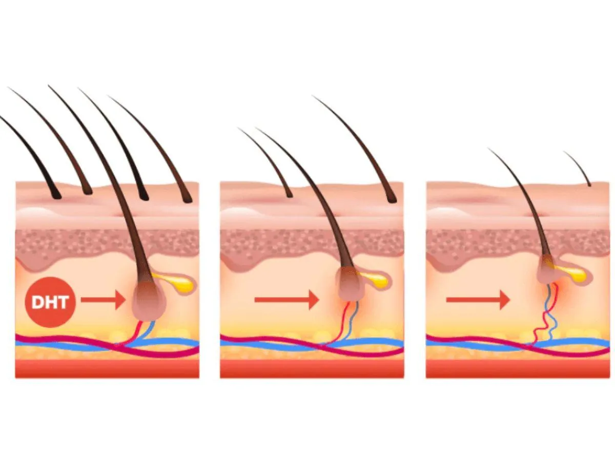 Tác động của DHT lên nang tóc gây ra chứng hói đầu kiểu nam giới