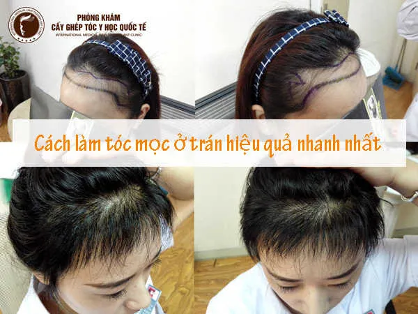 Người đàn ông rụng tóc vùng trán đang tìm kiếm cách làm mọc tóc