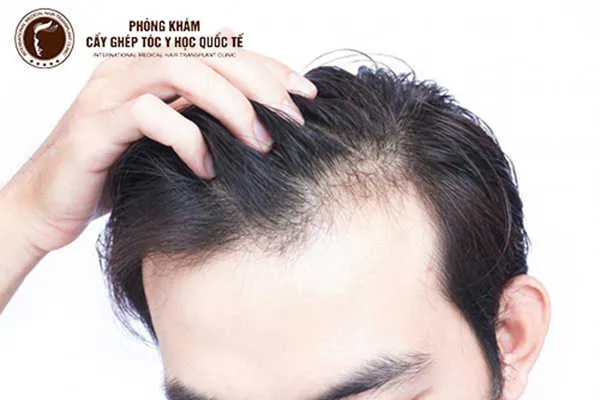 Hình ảnh minh họa một người đang massage da đầu với tinh dầu để kích thích mọc tóc