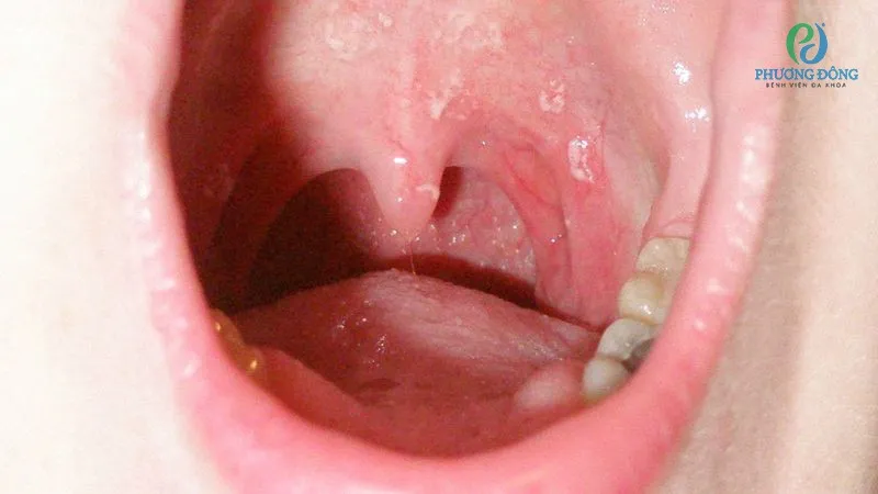 Người đang cố gắng nuốt nước bọt để đẩy sợi tóc bị mắc kẹt xuống cổ họng