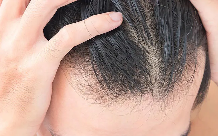 allintitle:cách tóc mọc nhiều: Hiểu rõ các yếu tố quyết định mật độ tóc