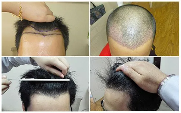 Hình ảnh minh họa kỹ thuật cấy tóc tự thân hiện đại