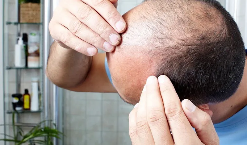 Mô tả các nguyên nhân phổ biến gây ra tình trạng rụng tóc và không mọc tóc con