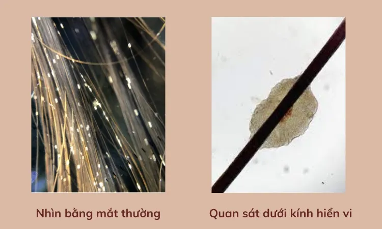 Hình ảnh cận cảnh các nốt sần màu trắng bám dính trên sợi tóc, minh họa trứng tóc trắng