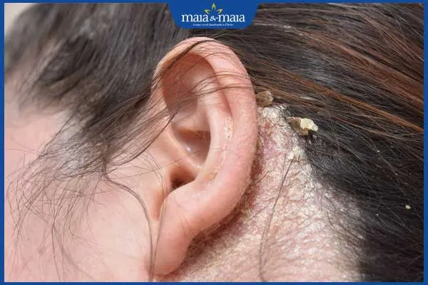 Nấm da đầu là một bệnh lý cần điều trị triệt để để khắc phục chân tóc yếu