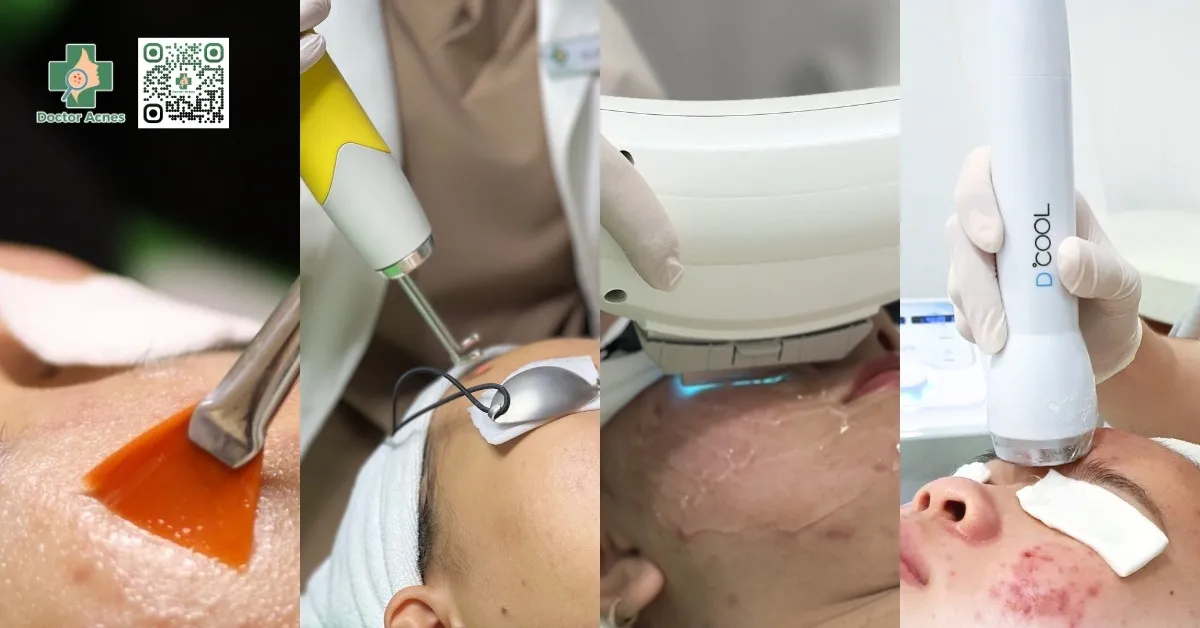 Minh họa các phương pháp điều trị mụn chuyên sâu, bao gồm Peel da, Laser, và Điện di, giúp giải quyết triệt để tình trạng mụn ở chân tóc