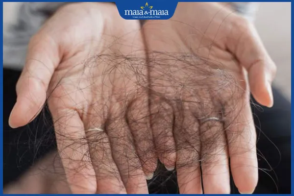 Rụng tóc nhiều là hậu quả thường gặp của việc cố gắng nhổ tóc sâu