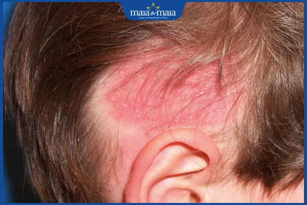 Rụng tóc kèm đỏ da đầu, cần tìm hiểu cách làm hết rụng tóc khoa học