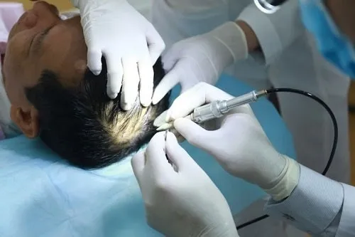 Biện pháp cấy tóc công nghệ cao là cách chữa rụng tóc ở tuổi dậy thì triệt để cho các trường hợp nghiêm trọng