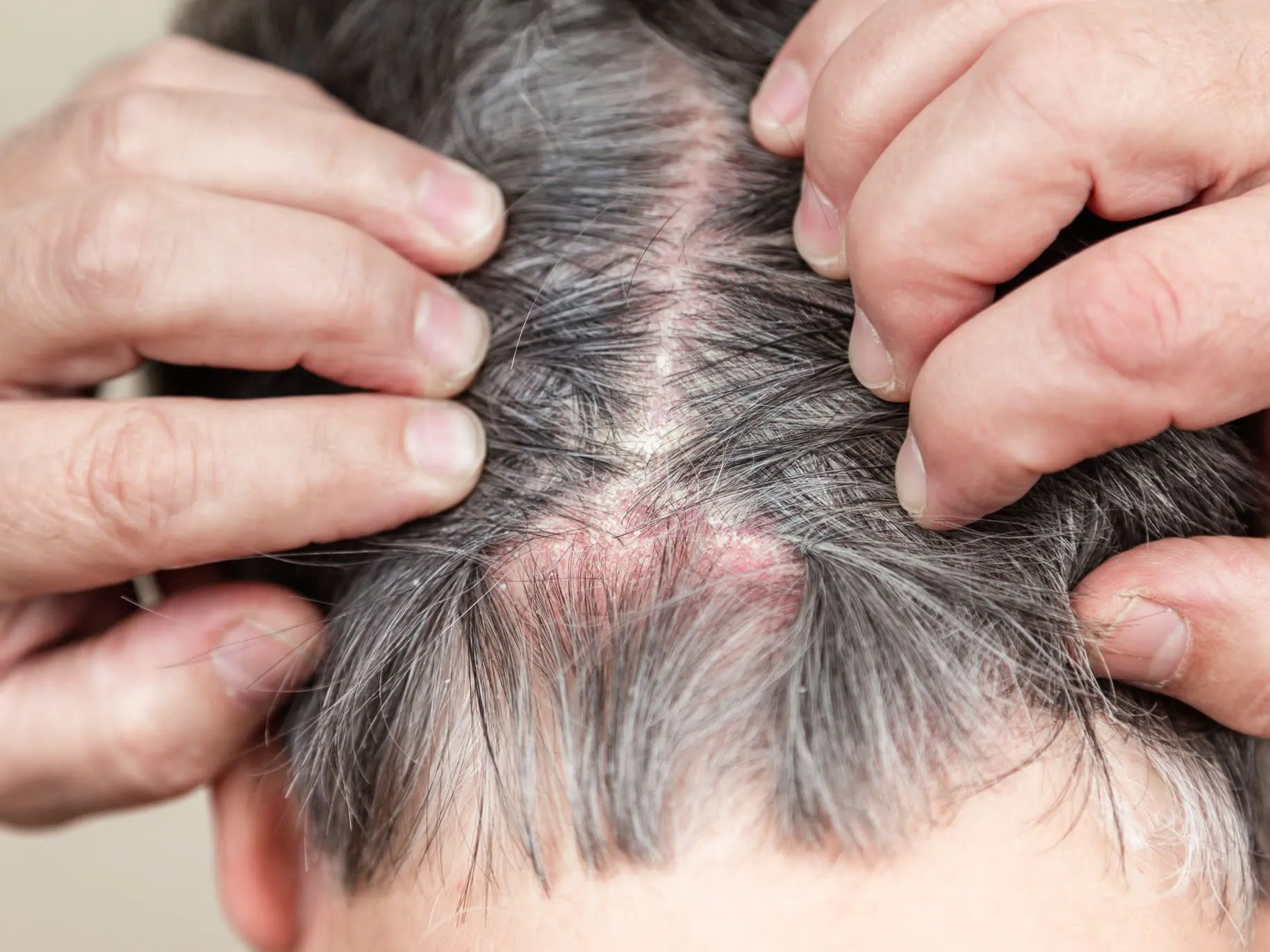 Hình ảnh cận cảnh da đầu bị kích ứng, mẩn đỏ do dị ứng với thành phần hóa học trong thuốc duỗi tóc