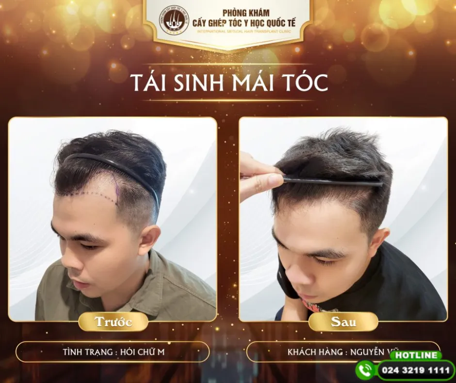 Hình ảnh các thiết bị và công nghệ chăm sóc tóc hiện đại (máy massage, máy chiếu laser) tại phòng khám chuyên khoa