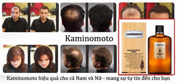 Sử dụng tinh chất nuôi dưỡng tóc chuyên sâu giúp ngăn ngừa rụng tóc và kích thích mọc tóc dày hơn