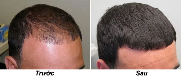 So sánh tình trạng tóc trước và sau khi áp dụng các liệu pháp chuyên sâu ngăn ngừa rụng tóc