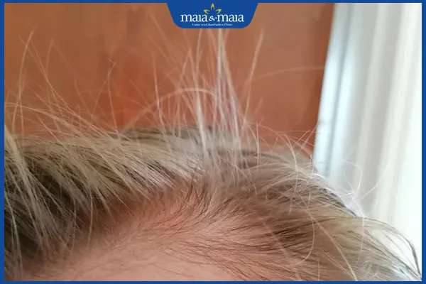 allintitle:cách khắc phục tóc con mọc lởm chởm trên da đầu