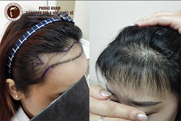 Áp dụng công nghệ cấy tóc tự thân là cách làm tóc dài nhanh nhất có thể cho các trường hợp hói đầu hoặc tóc rụng nặng