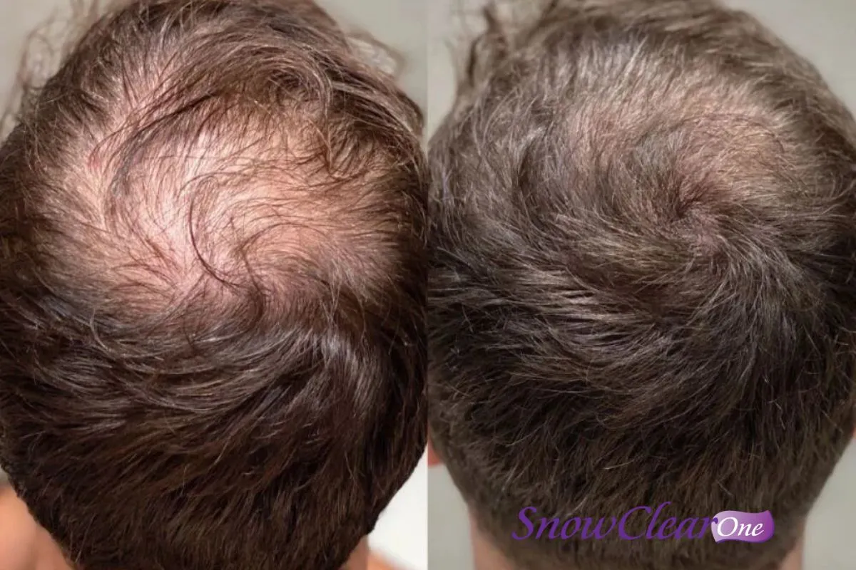 Yếu tố sinh học và dinh dưỡng ảnh hưởng đến allintitle:cách để tóc mái mọc nhanh