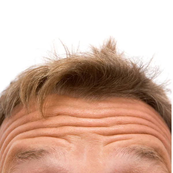 Rối loạn nội tiết tố là nguyên nhân hàng đầu gây nên tình trạng tóc mỏng thưa ở phụ nữ