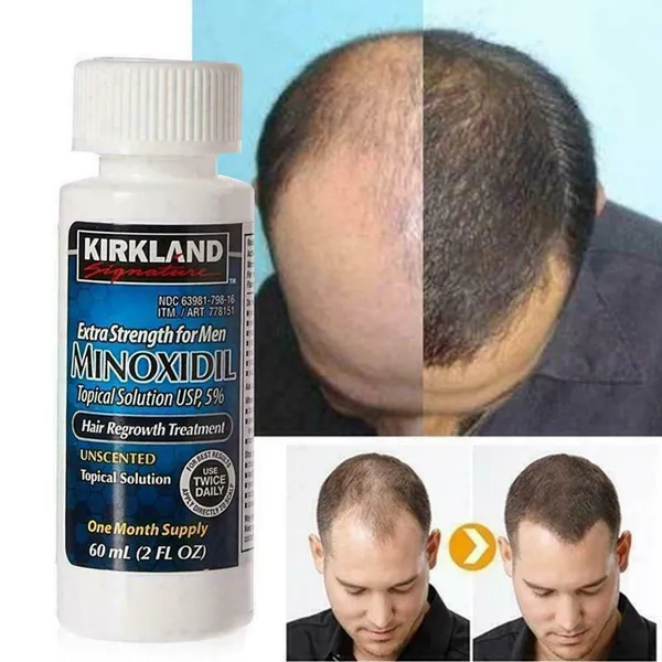 Minoxidil (Rogaine) là một loại thuốc bôi ngoài da phổ biến, được công nhận trong việc điều trị hói đầu
