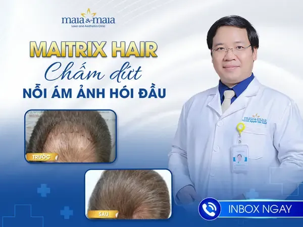 Điều trị rụng tóc bằng công nghệ Maitrix Hair, giải pháp cách làm hết rụng tóc hiện đại