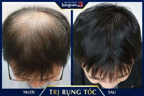 Ứng dụng công nghệ cao trong cách trị rụng tóc ở tuổi dậy thì