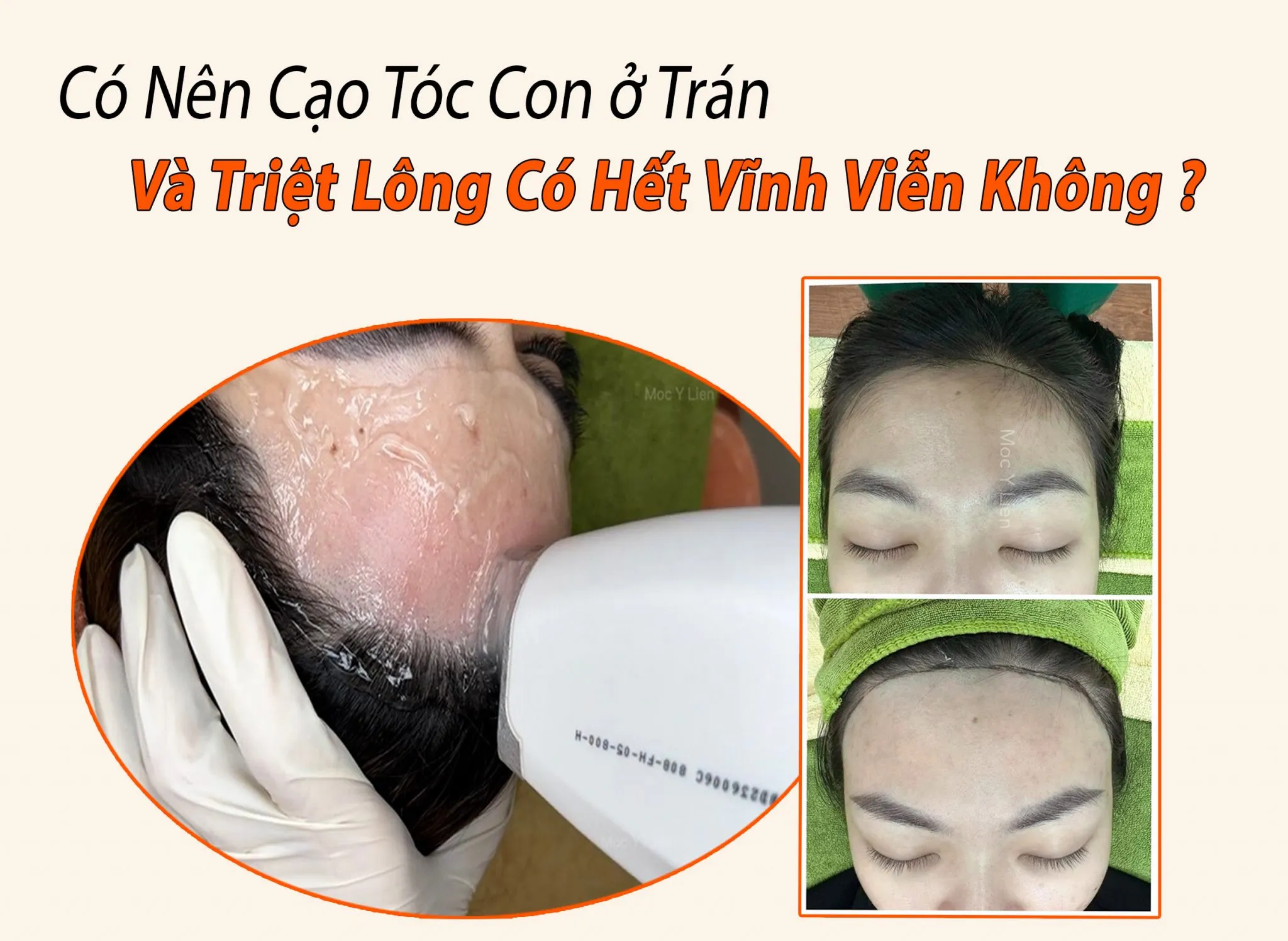 Hiệu quả rõ rệt sau khi triệt tóc vĩnh viễn bằng Laser Diode