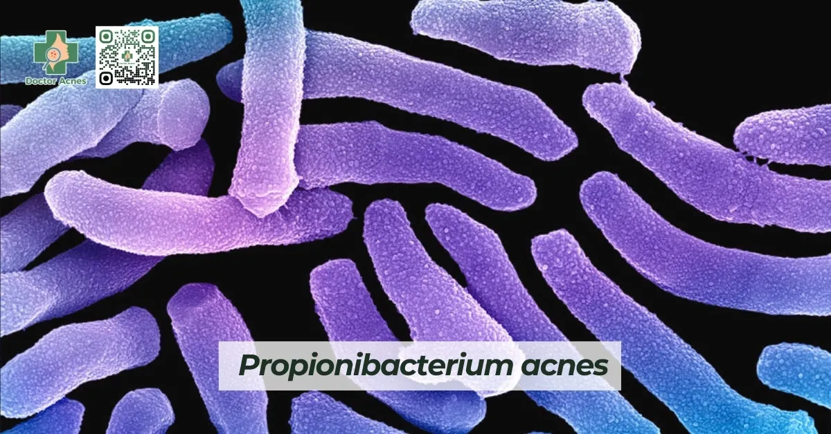 Vi khuẩn Propionibacterium acnes là một trong những nguyên nhân phổ biến gây ra tình trạng mụn nang lông viêm nhiễm ở chân tóc