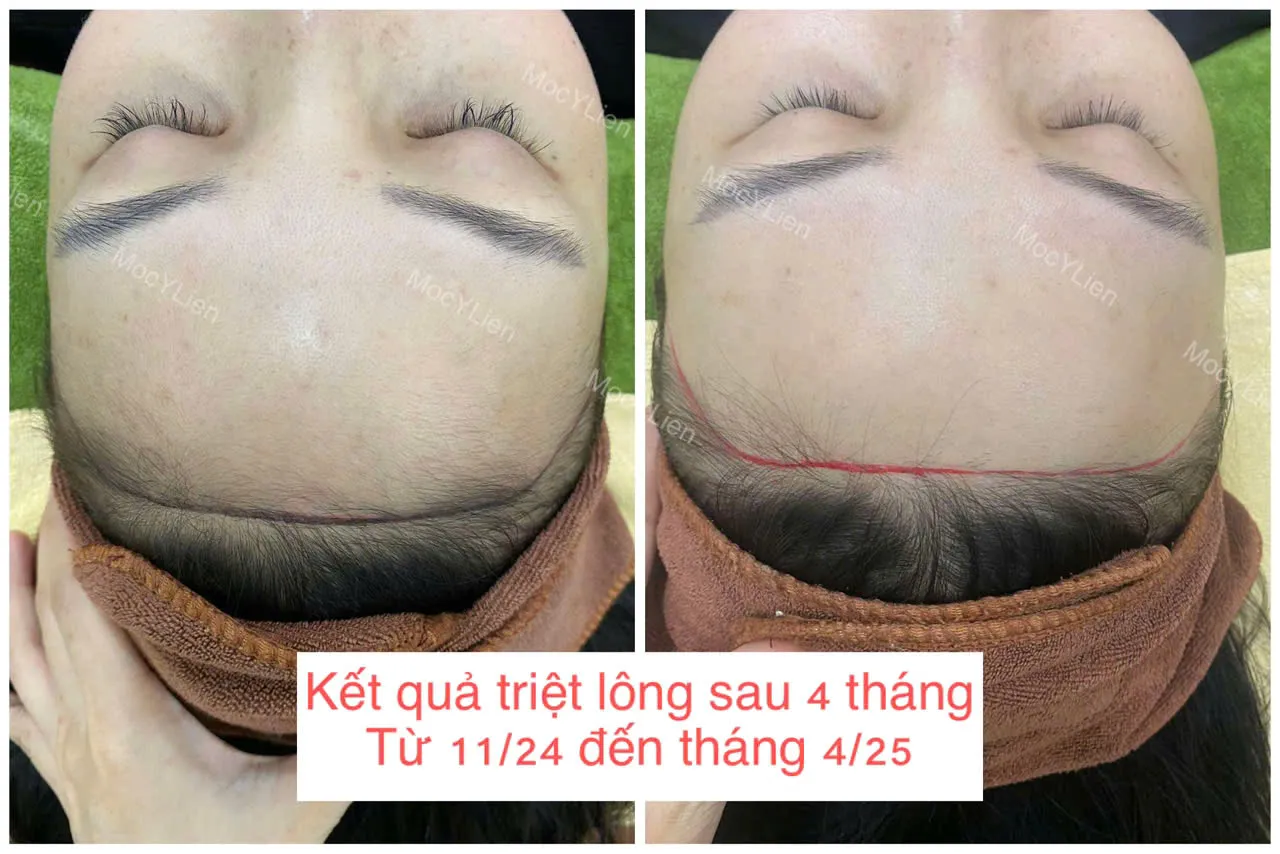 So sánh các cách triệt tóc vĩnh viễn không đau rát